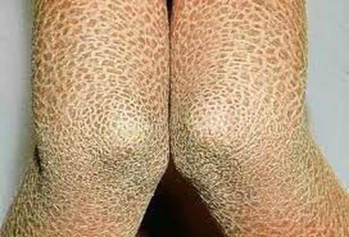 What causes ichthyosis vulgaris?
