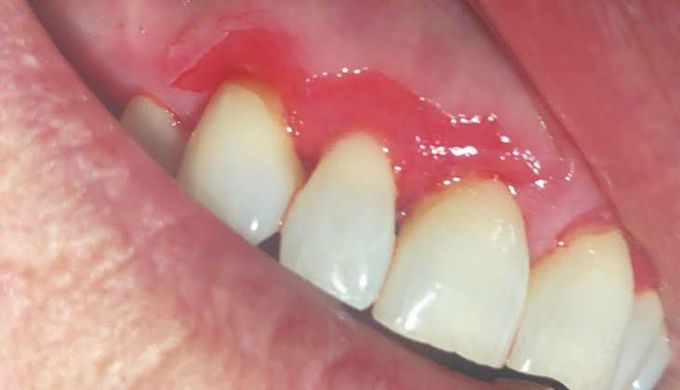 Desquamative gingivitis