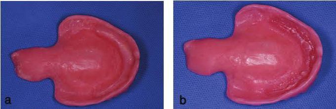 Intaglio surface of denture