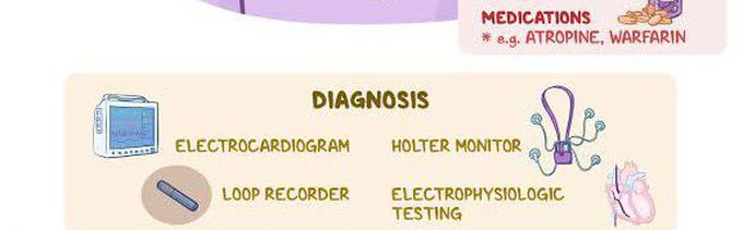 This is the diagnosis of Sick Sinus syndrome