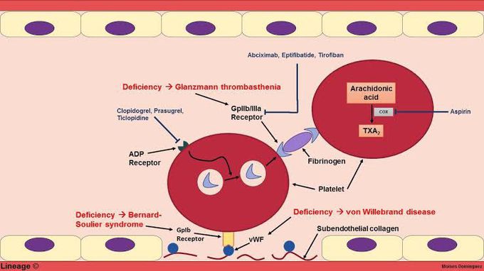 Glanzmann thrombasthenia