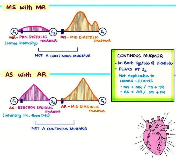 Continuous Murmur I