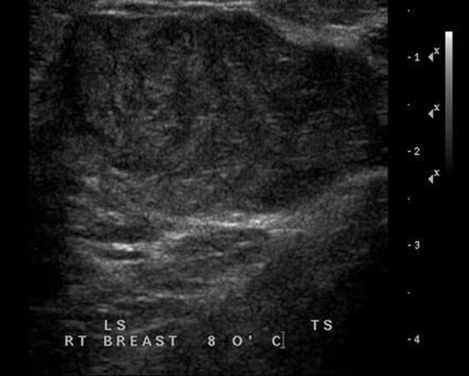 Phyllodes tumor causes