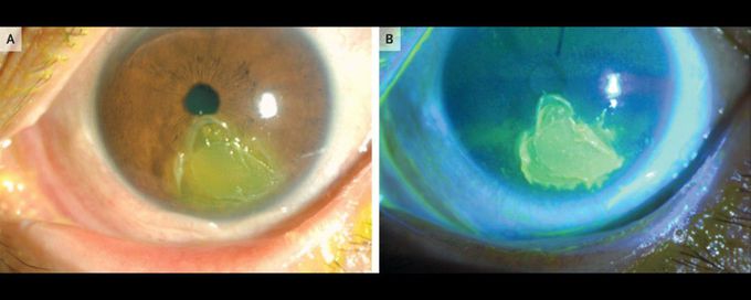 Autoimmune Keratitis after Atezolizumab Treatment