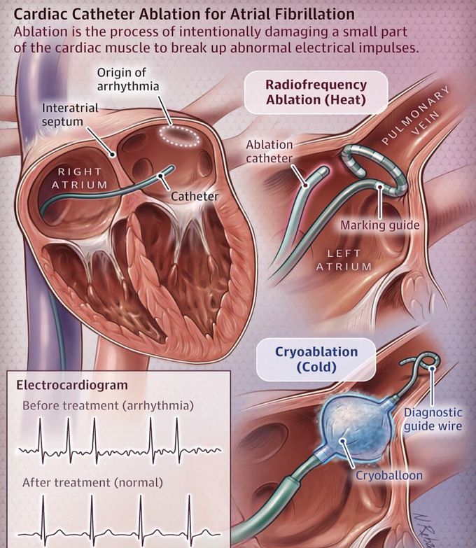 Cardiac catheterization for Afib