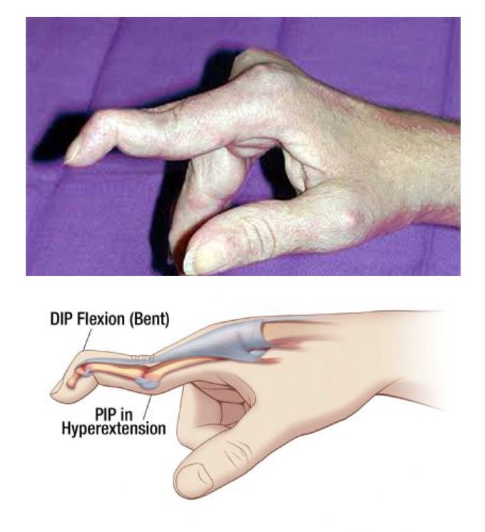 Swan neck deformity