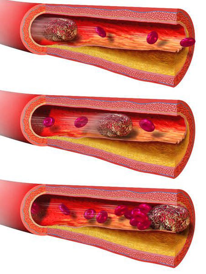 Thrombus
