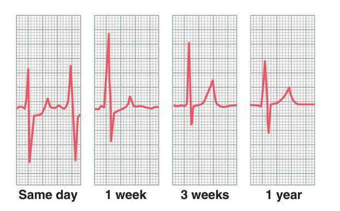 Posterior wall infarction