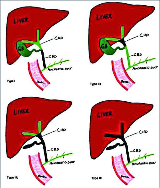 Biliary Atresia Classification - MEDizzy