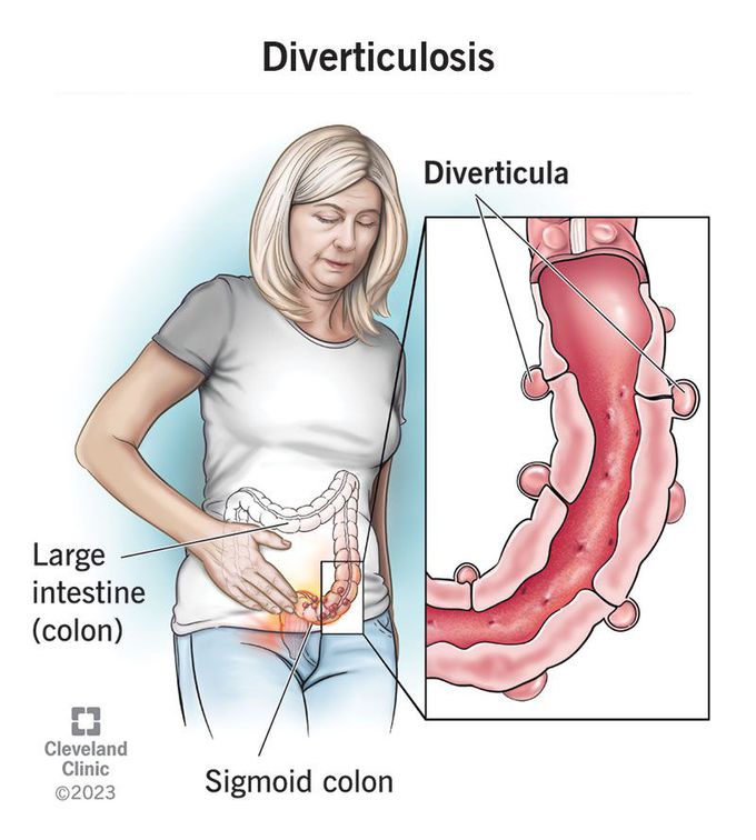 Symptoms of diverticulosis