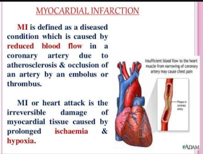 Myocardial infarction
