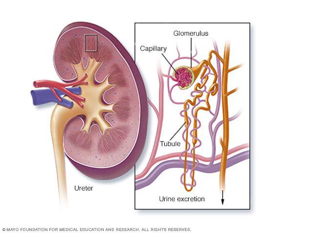 Nephrotic Syndrome Medizzy 4019