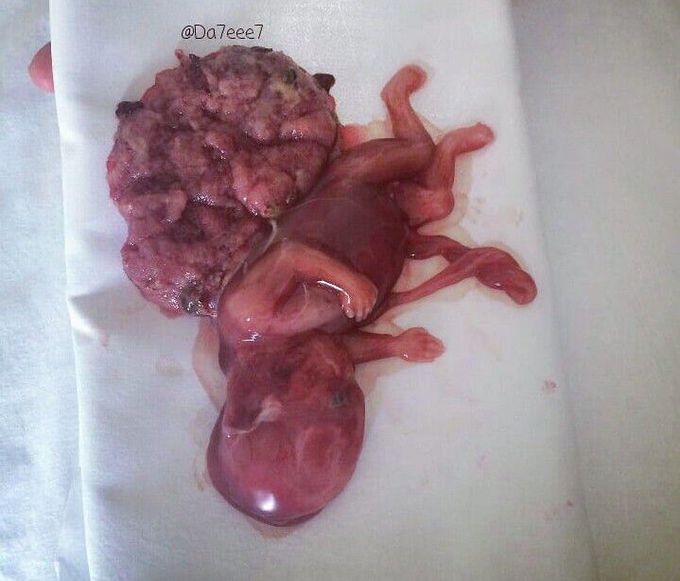 Intrauterine-death of 16 weeks old fetus