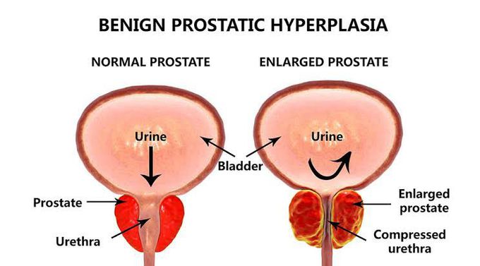 Benign Prostatic Hyperplasia