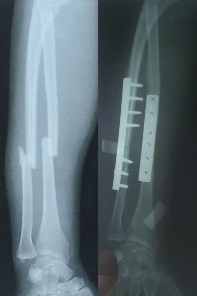 Fx Radius & Ulna shaft