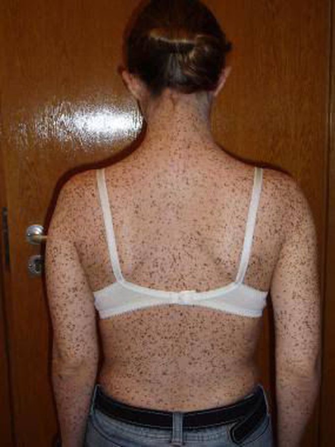 Derma