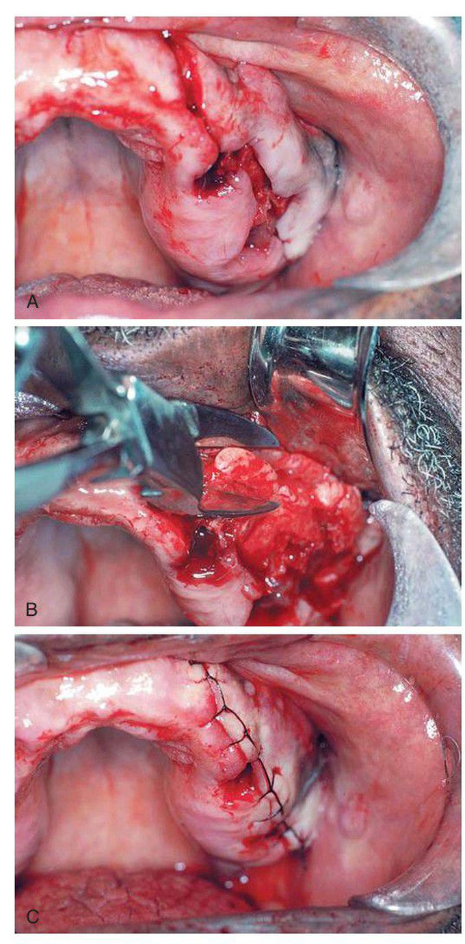 Removal of buccal exostosis