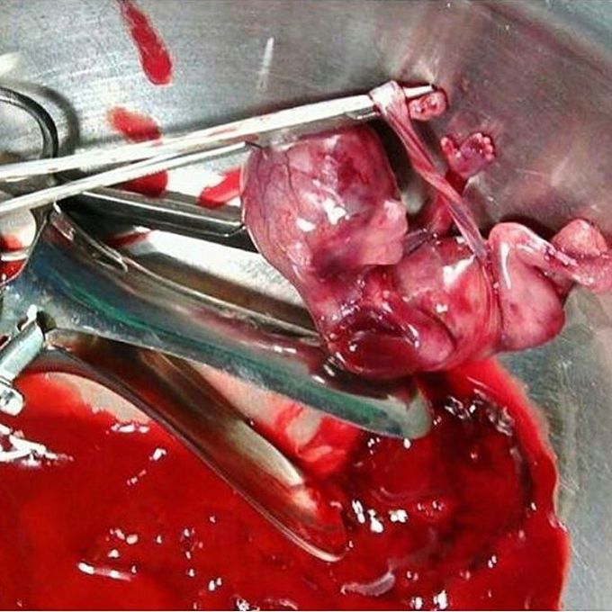 A tiny little fetus spontaneously aborted due to pregnancy complications!  