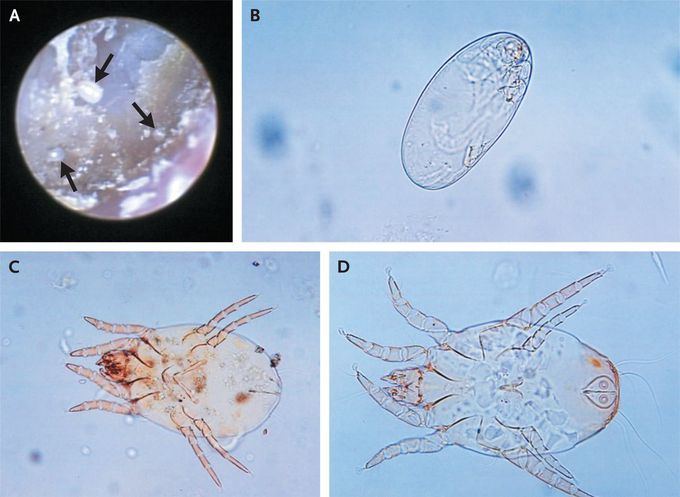 Mites in the External Auditory Canal