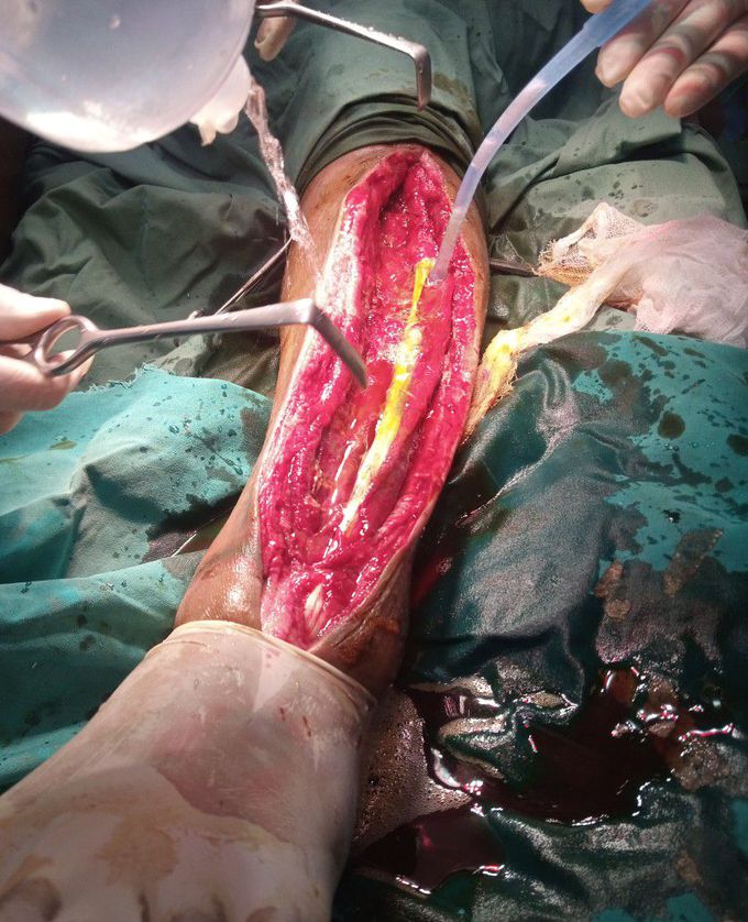 Case of SSI after implantation in tibia