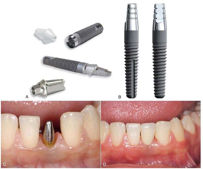 Single-stage and two-stage implants