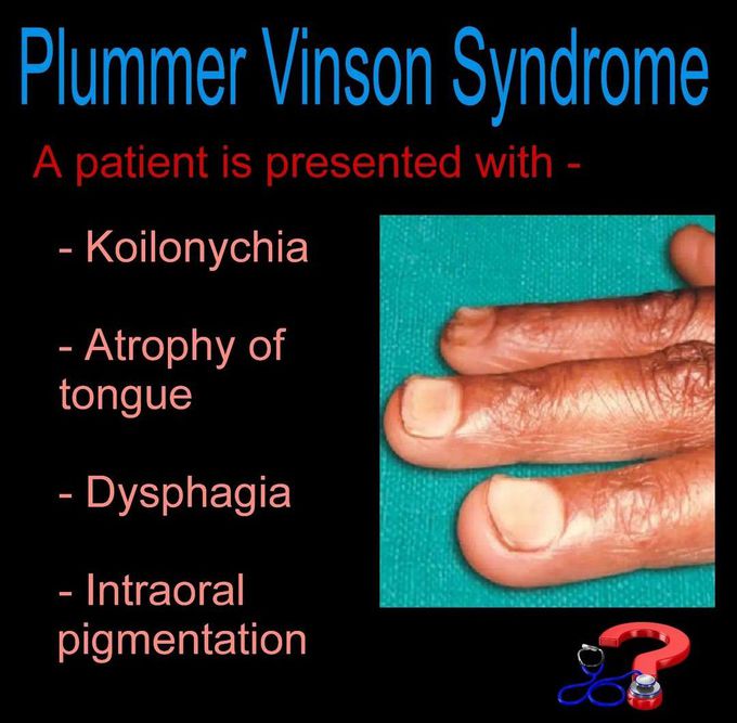 Plummer Vinson Syndrome
