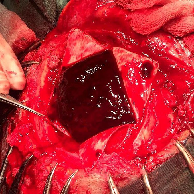 Bleeding into the brain!