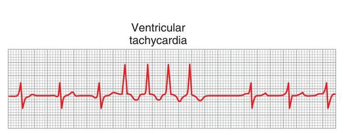 Ventricular tachycardia