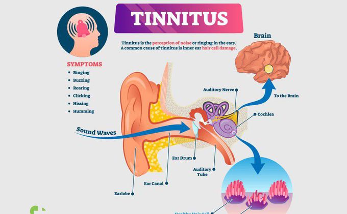 Tinitis