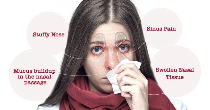 Nasal congestion