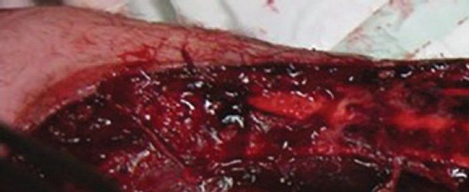 Case Of Degloving Injury In Upper Extremity In 38-Year-Old
