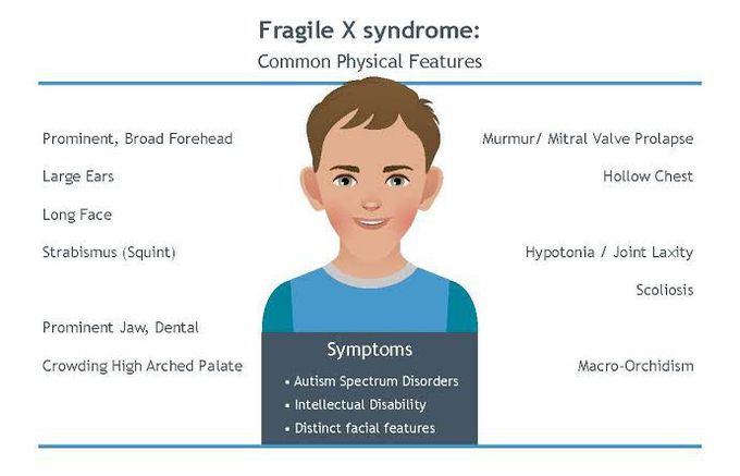 These are the symptoms of Fragile X syndrome