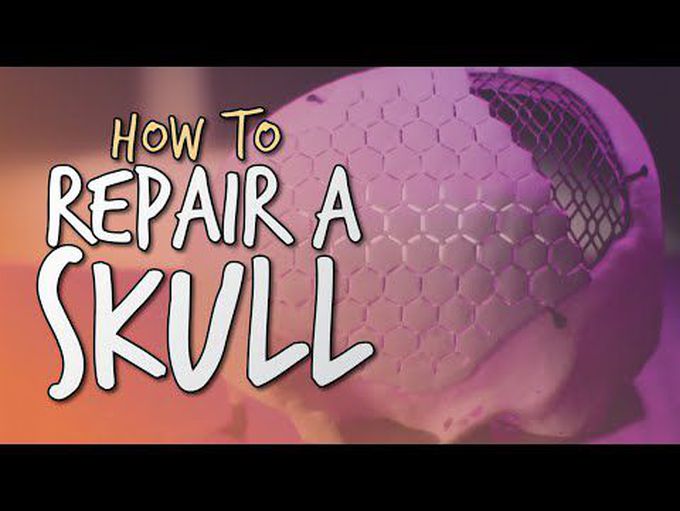 Cranioplasty procedure - GoPro footage