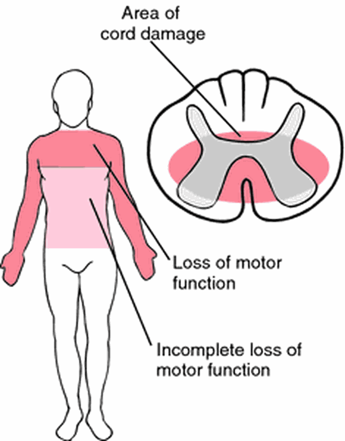 Treatment of central cord syndrome