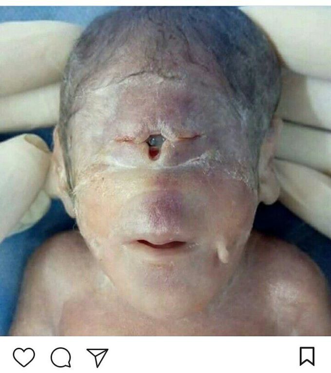 Cyclopia