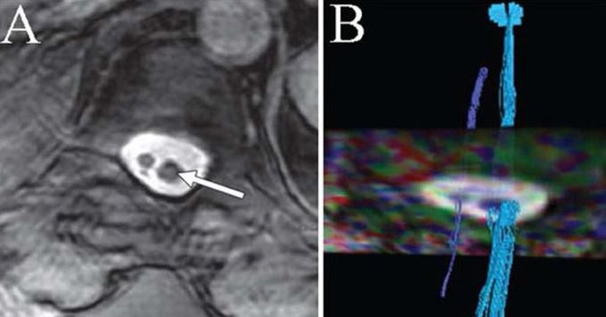 Tractography for spinal dysraphism