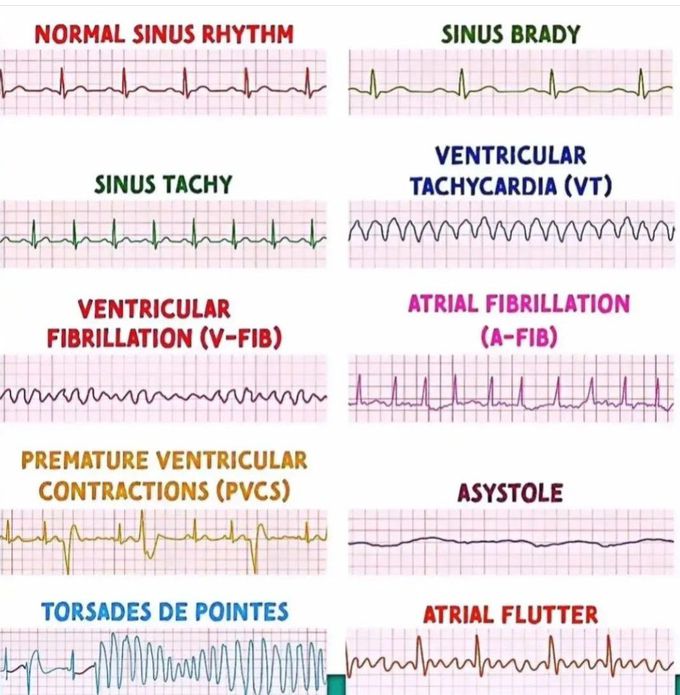 ECG Review