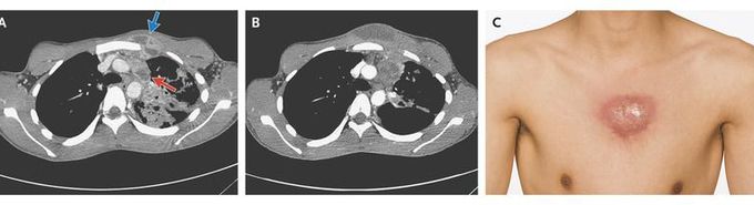 Tuberculous Abscess