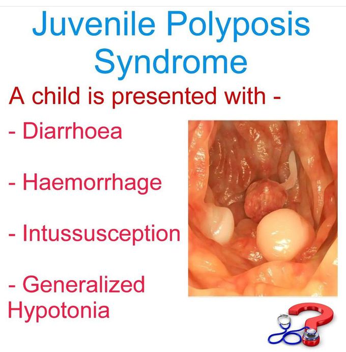 Juvenile Polyposis Syndrome