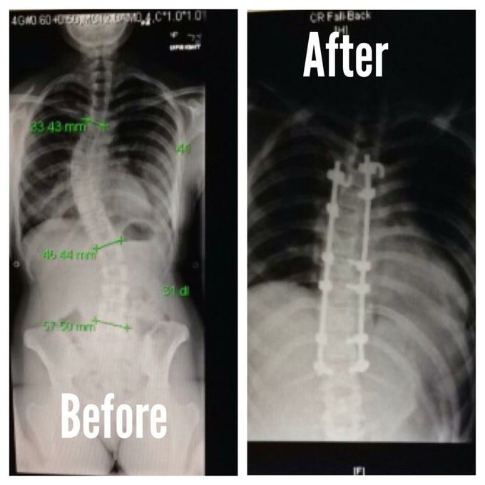 Scoliosis