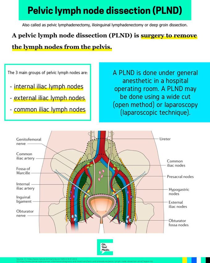 Pelvic Lymph Nodes Dissection