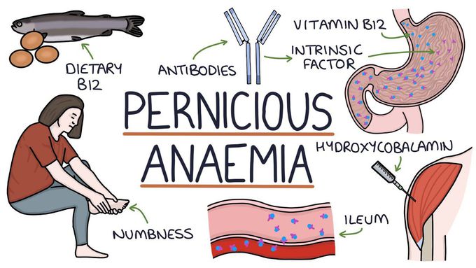 Pernicious Anaemia made easy