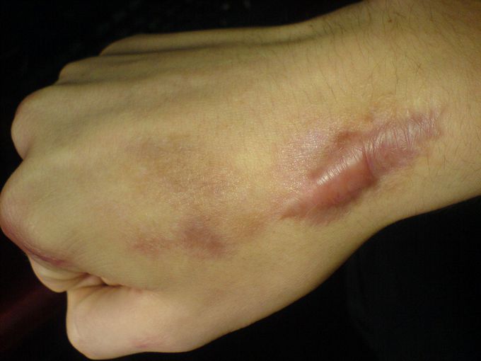 KELOID