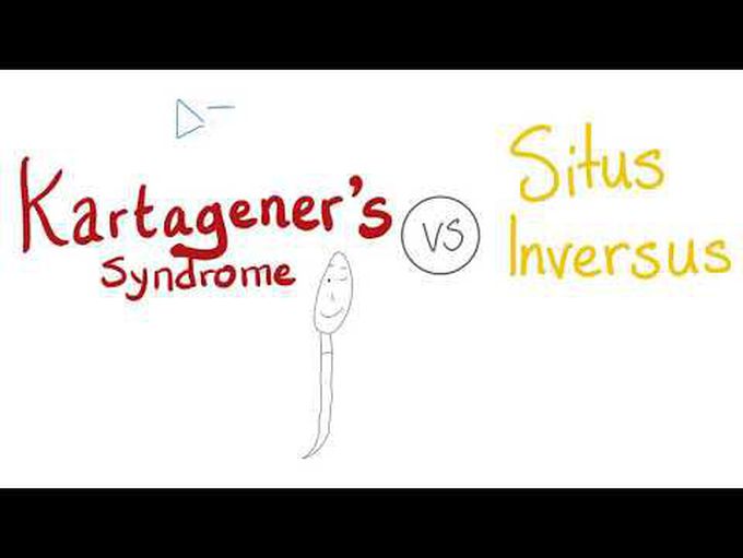 Kartagener's Syndrome VS Situs Inversus Totalis