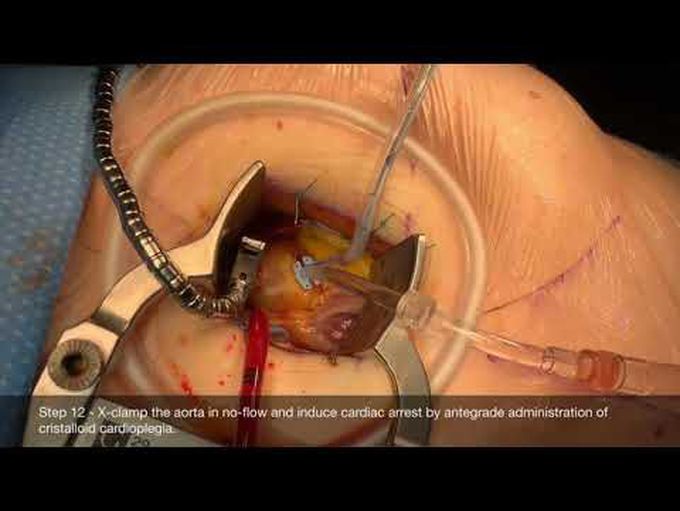 Surgery Without Visible Scars: The Right Lateral Access for Minimally Invasive Aortic Valve Surgery