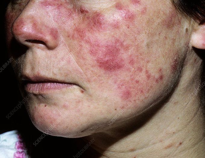 Autoantibodies Found in Systemic Lupus Erythematosus