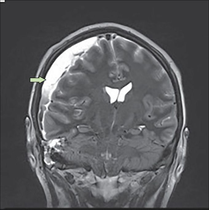 Subdural Empyema