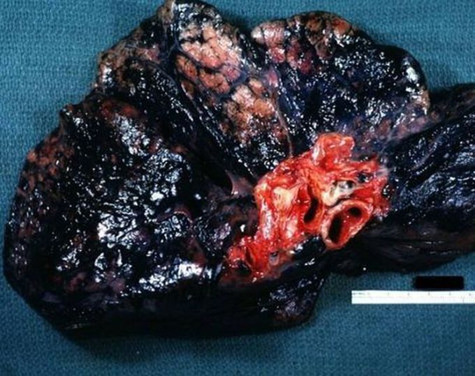 Lungs diseases