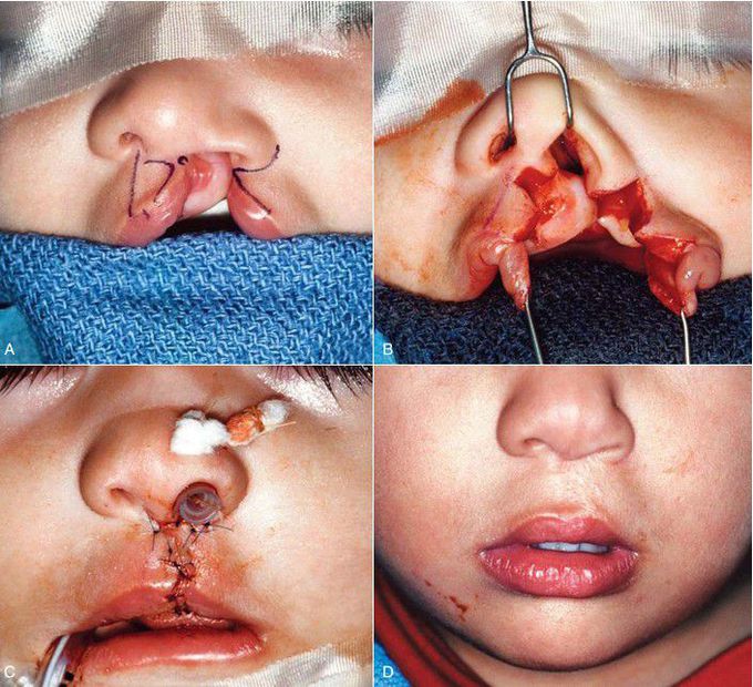 Cleft lip surgery