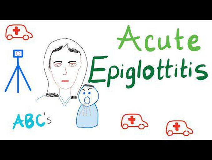 Acute Epiglottitis
